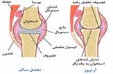 علل افزایش آرتروز زانو در ایرانیان