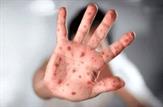 علائم و نحوه انتقال بیماری خطرناک  ام پاکس (آبله میمونی)